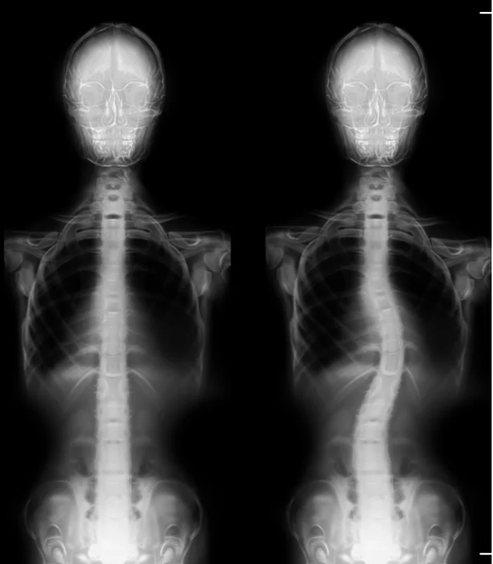 Scoliosis Treatment In Lansing